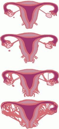 endometriose cervical 